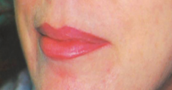 Lip Enhancement After