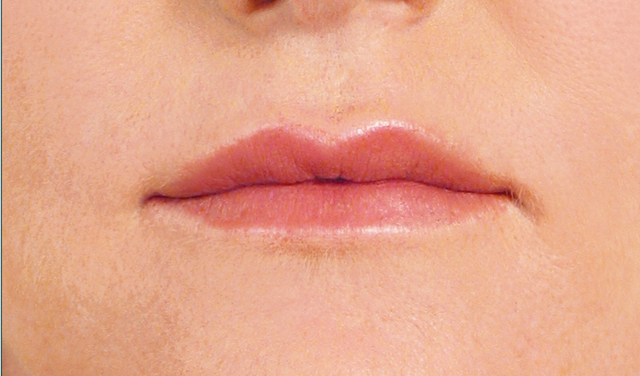 Lip Enhancement After